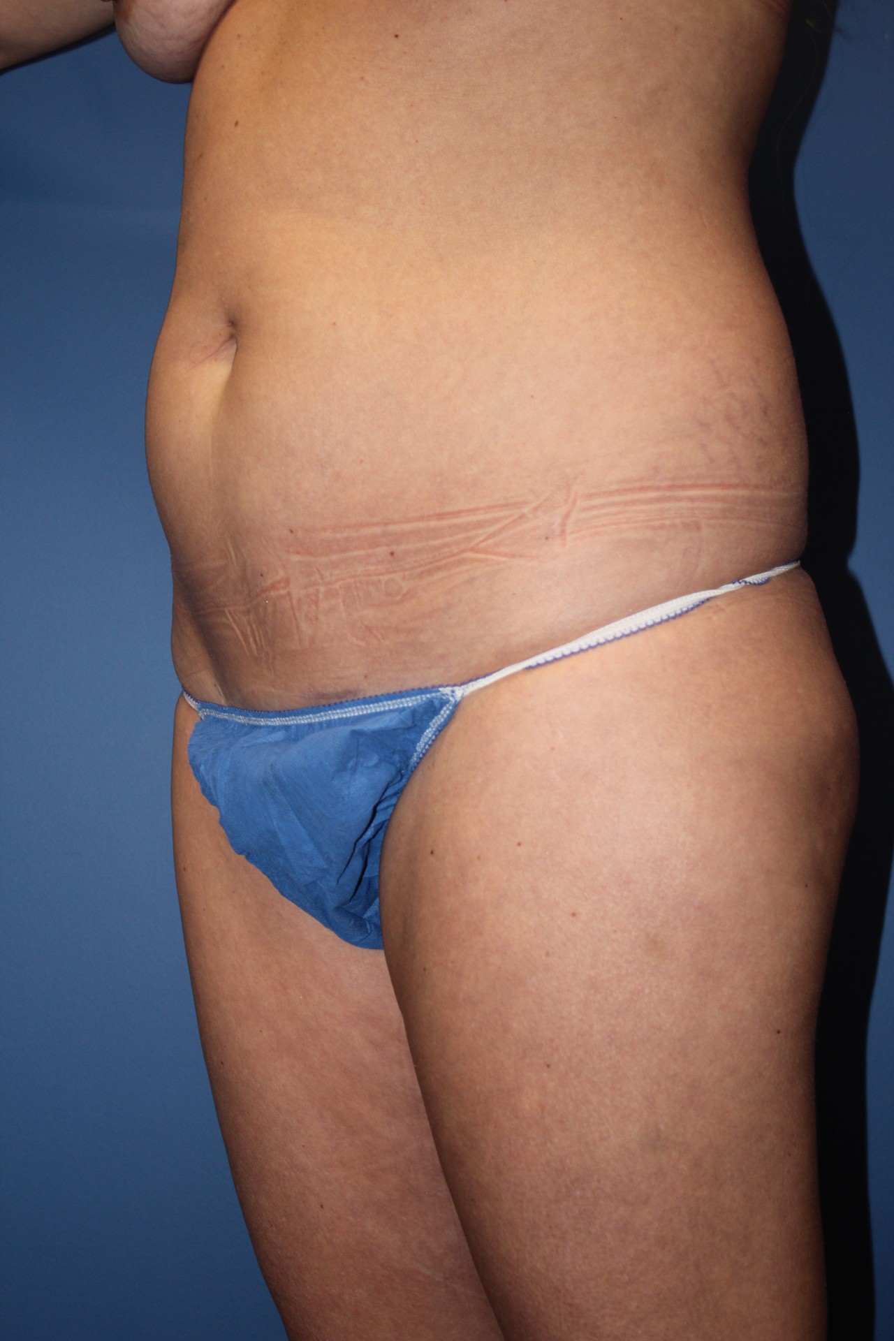 TummyTuckAfter1_SurekPlasticSurgery