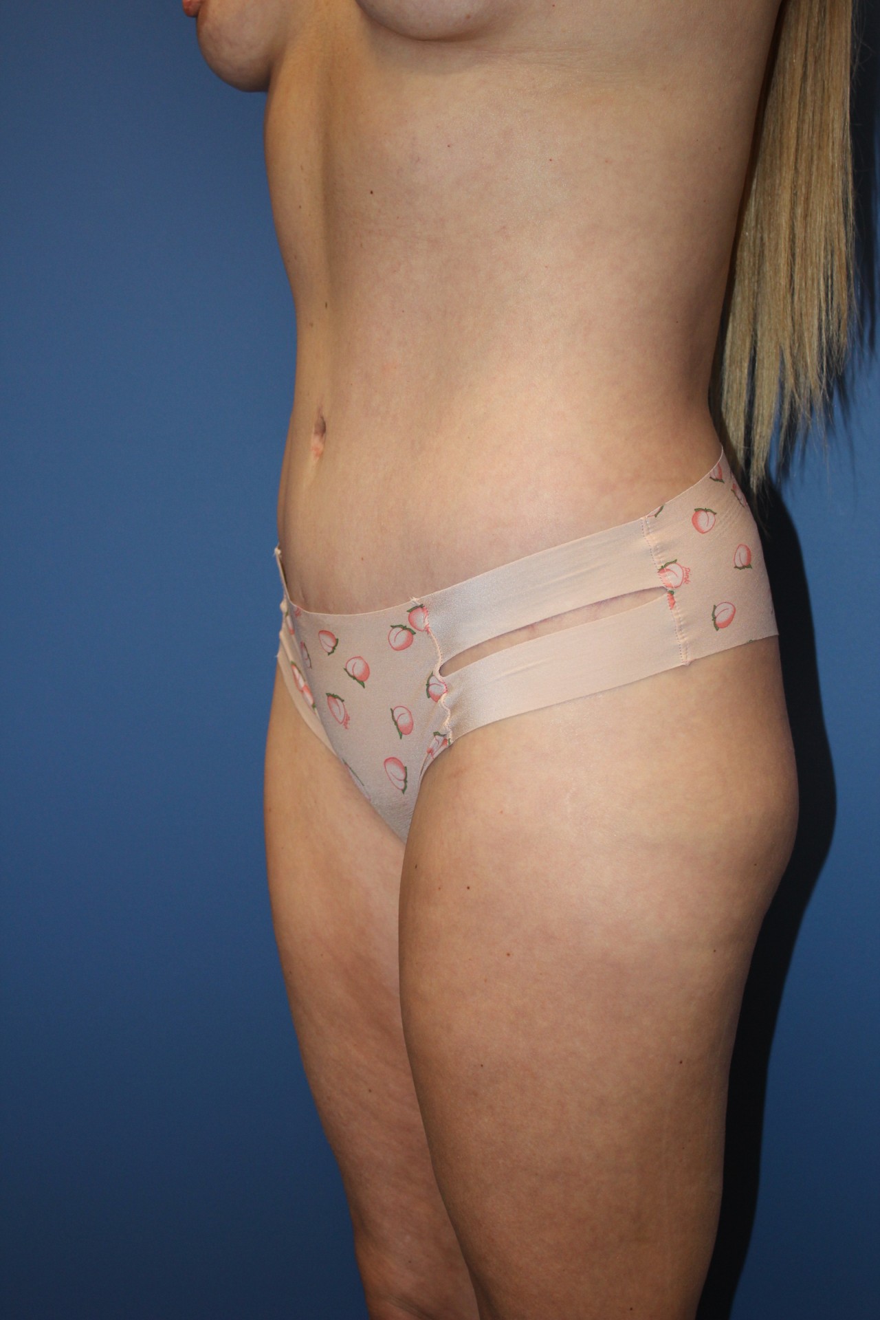 TummyTuckBefore1_SurekPlasticSurgery