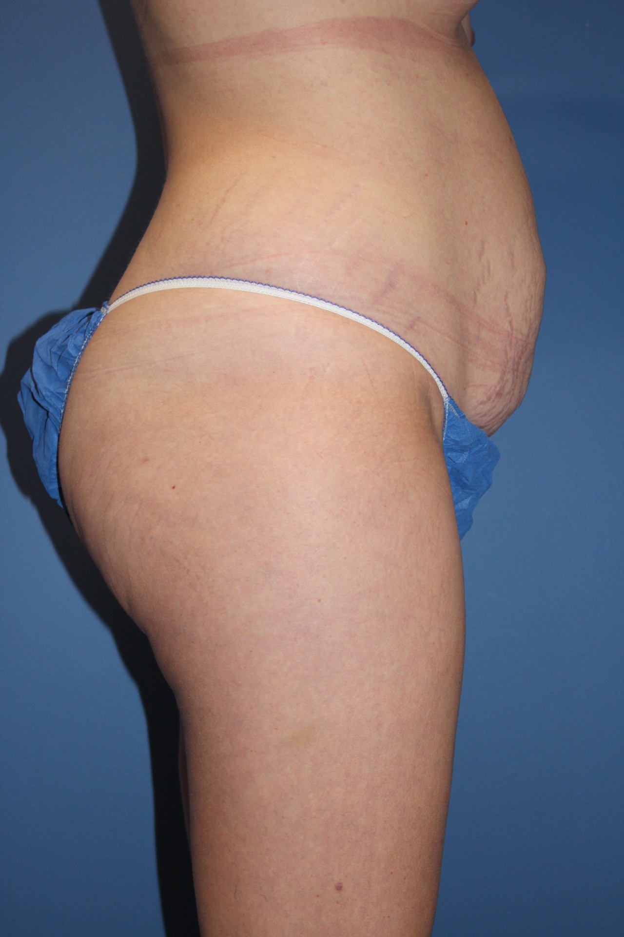 TummyTuckBefore2_SurekPlasticSurgery