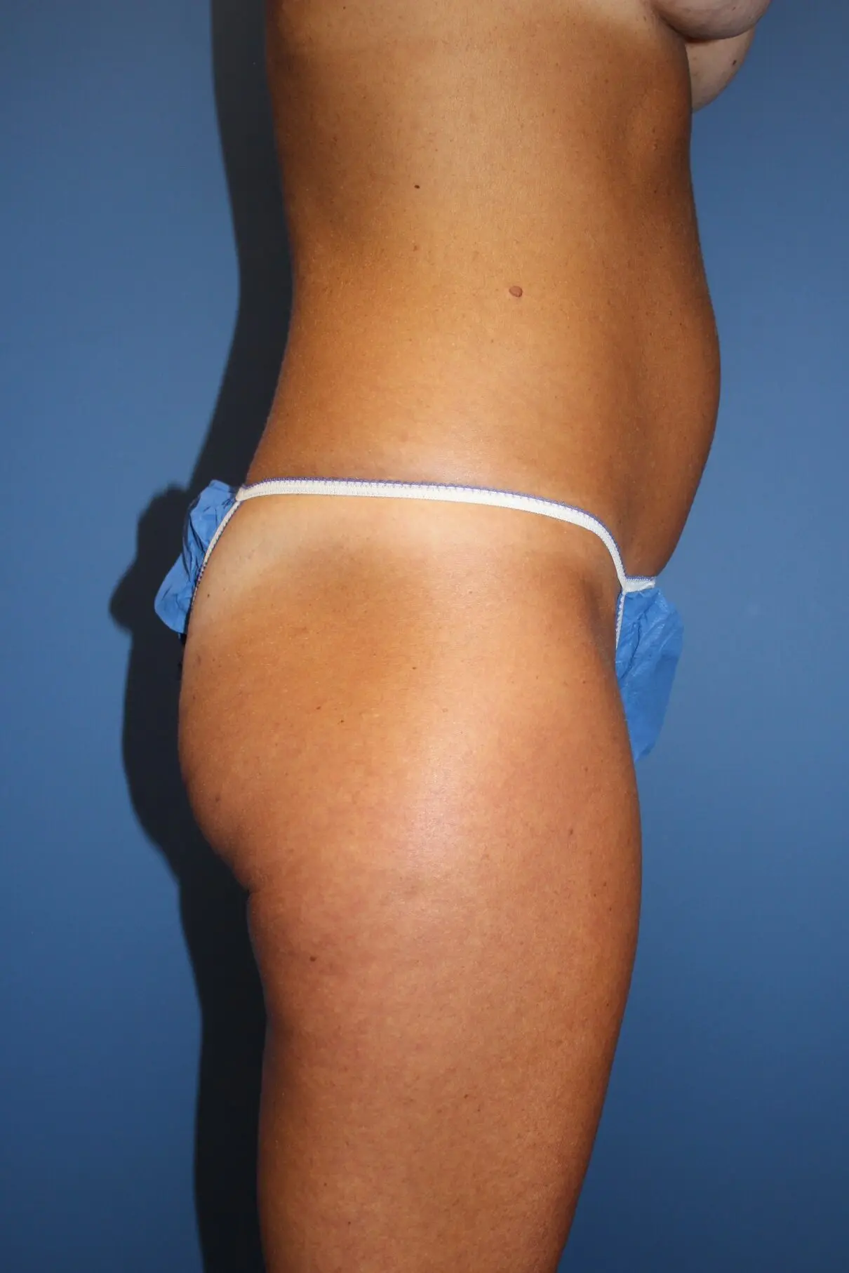 TummyTuckBefore5_SurekPlasticSurgery-e1768335065642