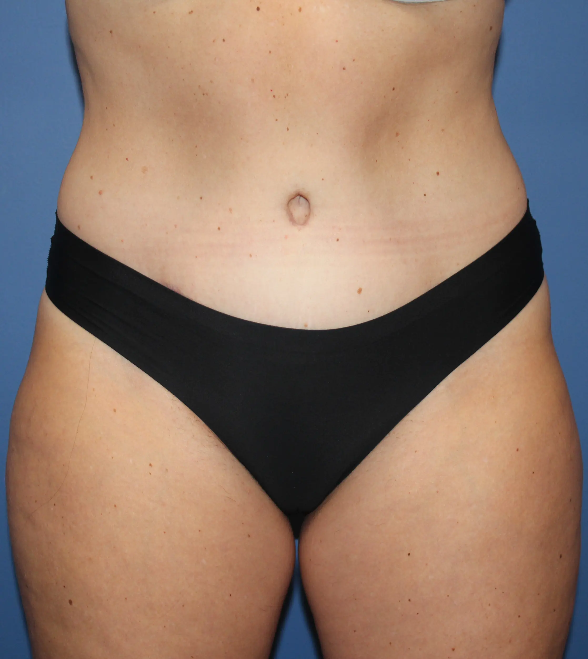 TummyTuckLipoAfter_SurekPlasticSurgery