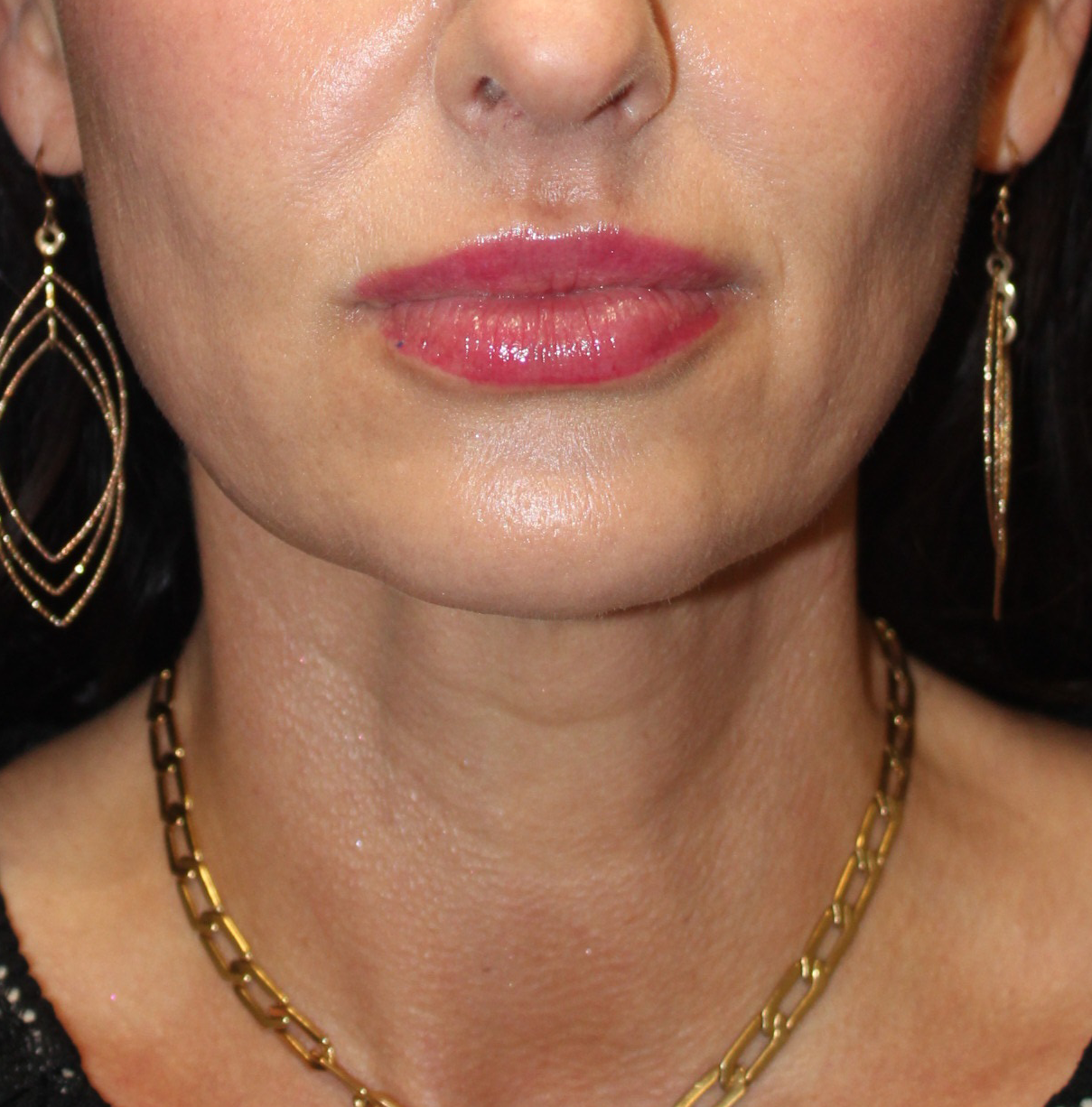 Woman's neck after a necklift