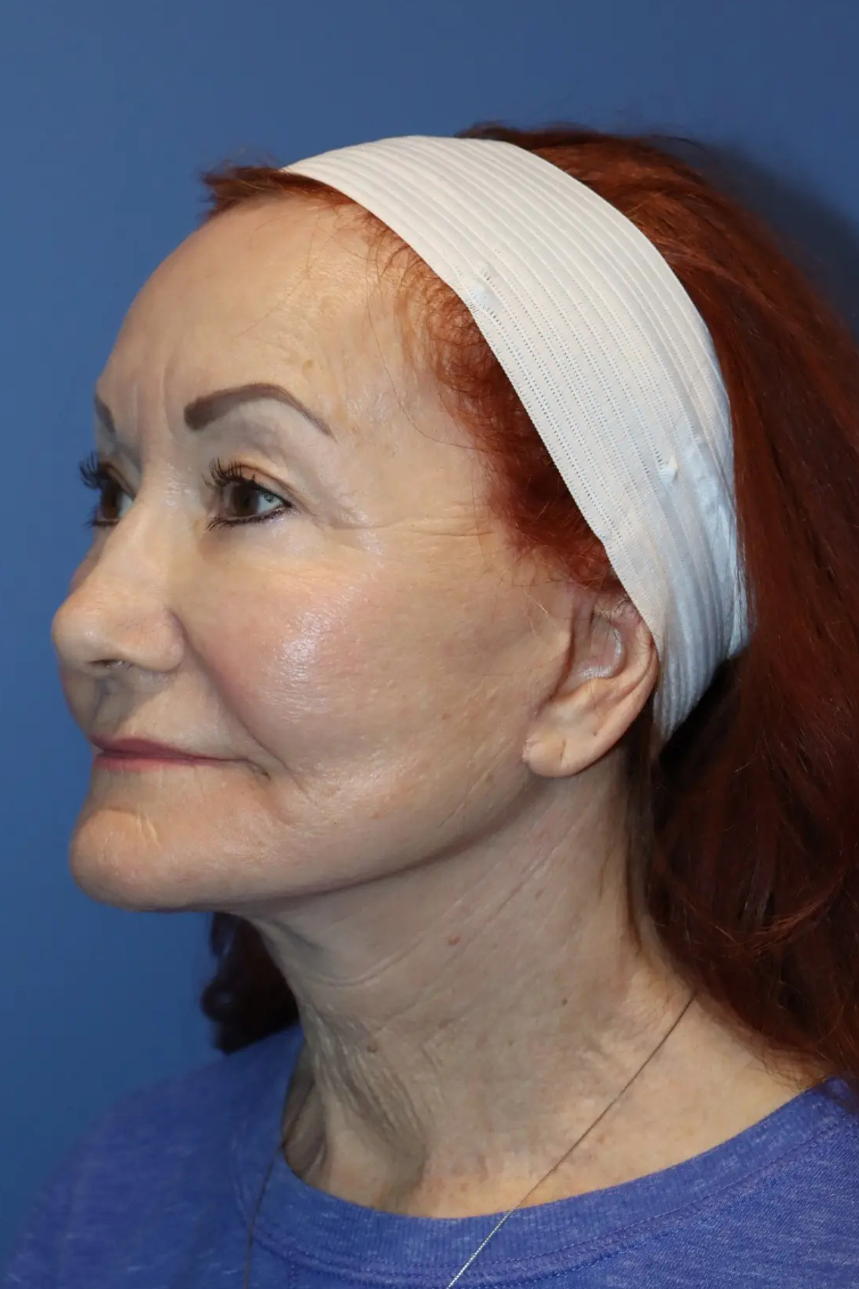 Woman after a cosmetic procedure