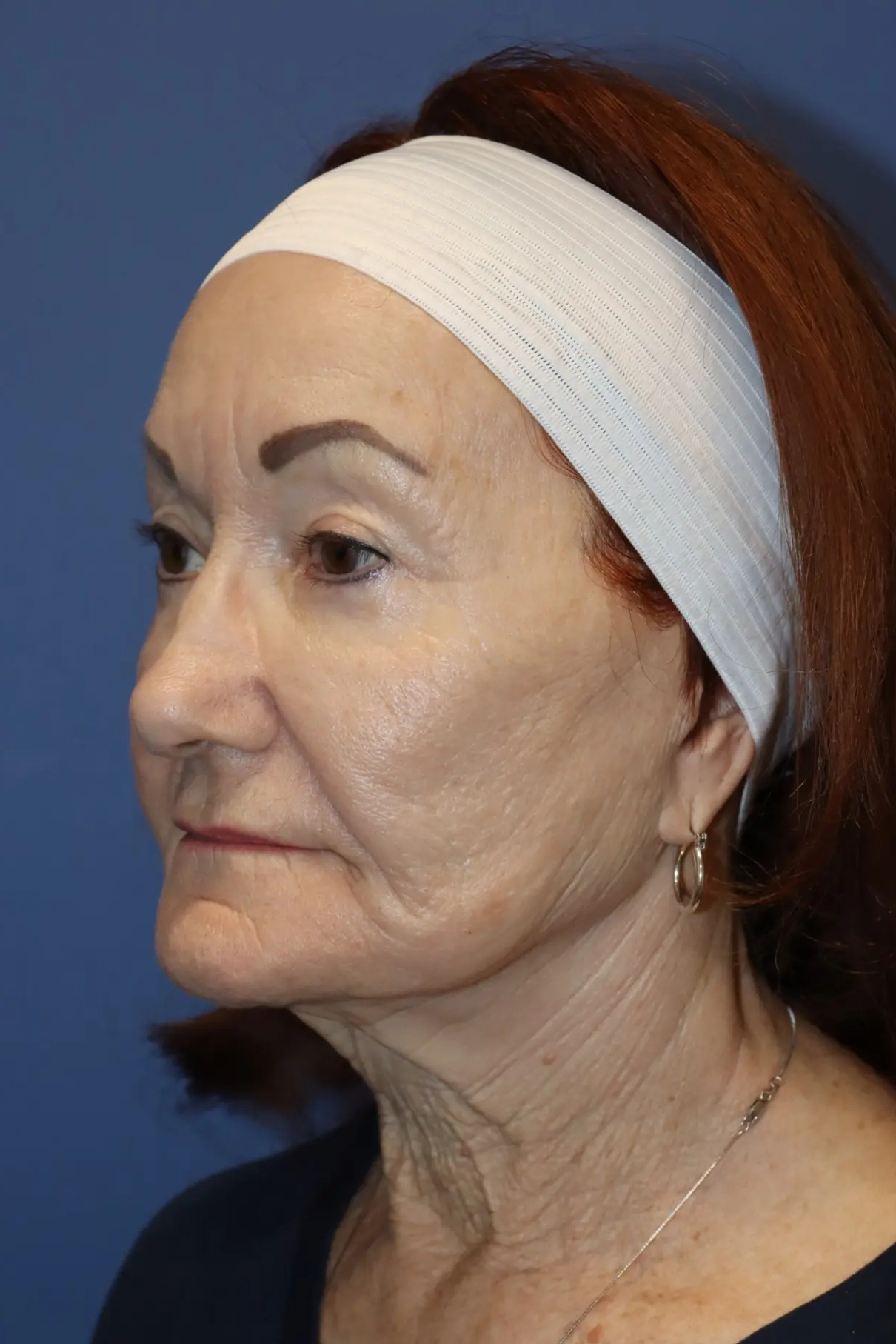 Woman before a cosmetic procedure