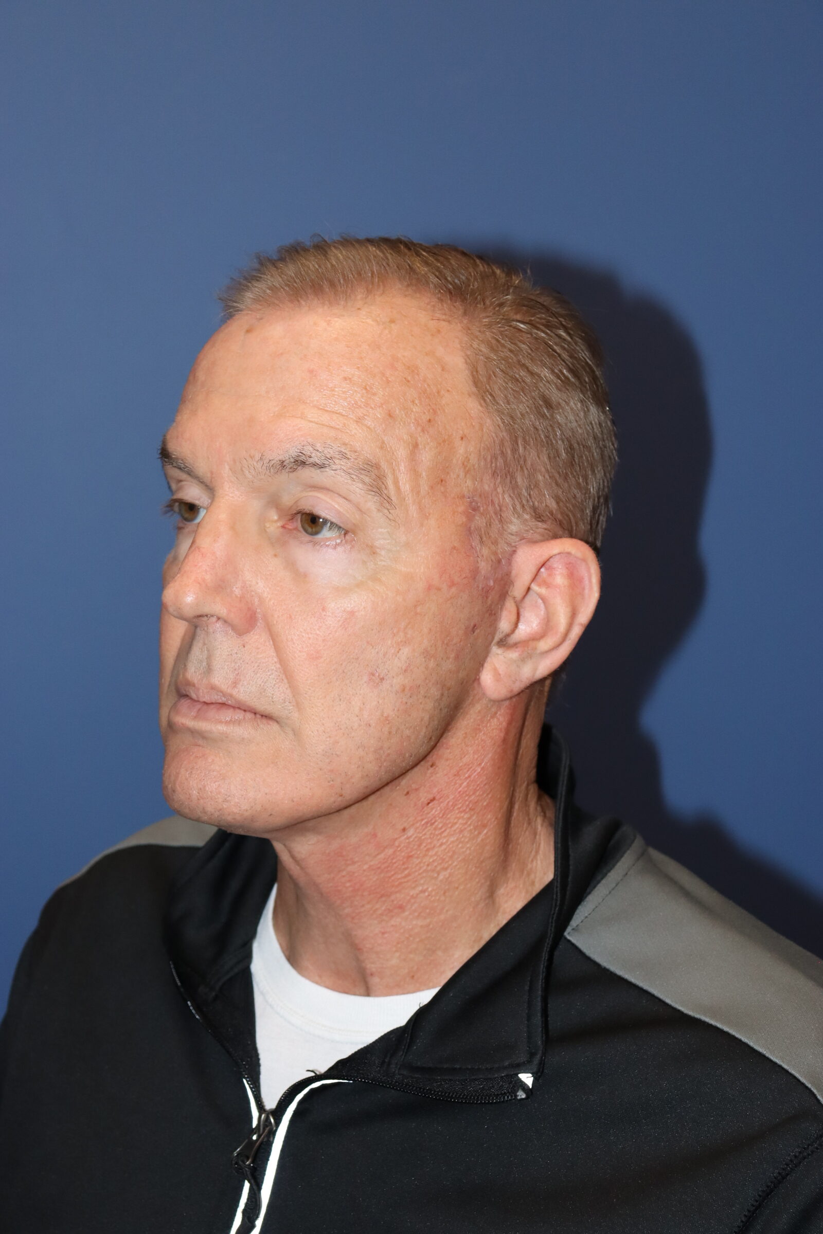 Male Facelift & Deep Necklift. Left Oblique. After image