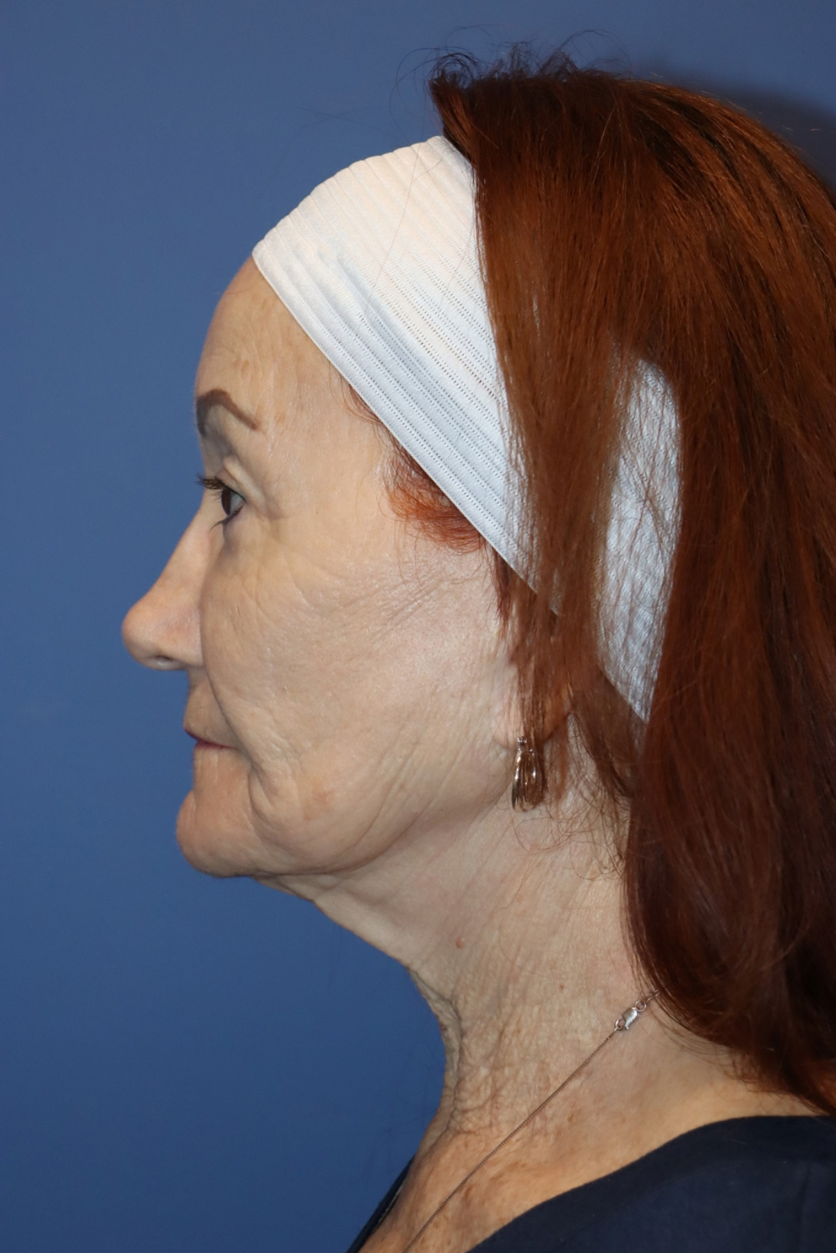 Older woman's face before a facelift